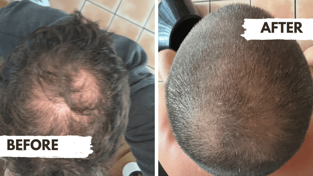 Regrow hair loss product review James