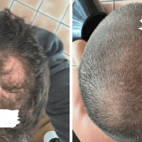 Regrow hair loss product review James