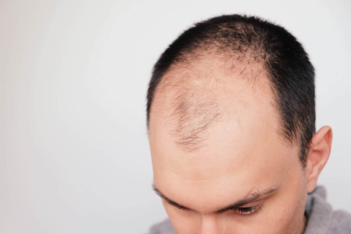 Male,pattern,hair,loss,problem,concept.,young,man,losing,hair